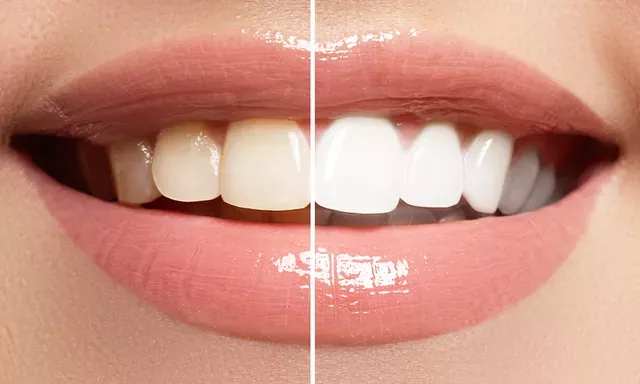 Teeth Whitening Sherman Oaks -Close-up of teeth before and after whitening procedure - Sherman Oaks Smile Studio