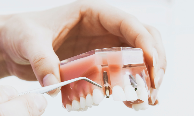 Dental Bonding - Dentist Sherman oaks, CA