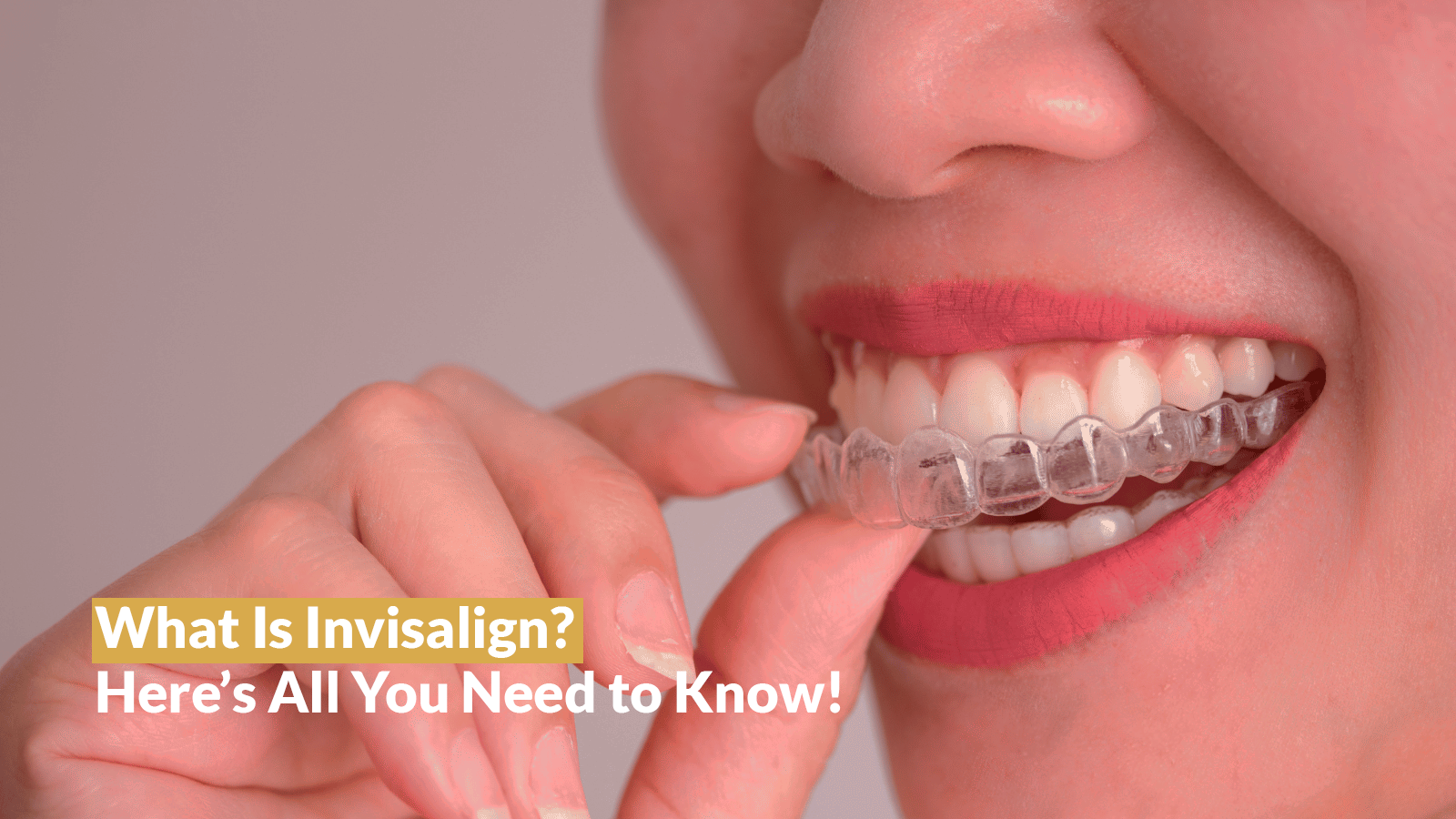 What Is Invisalign? Here’s All You Need to Know!