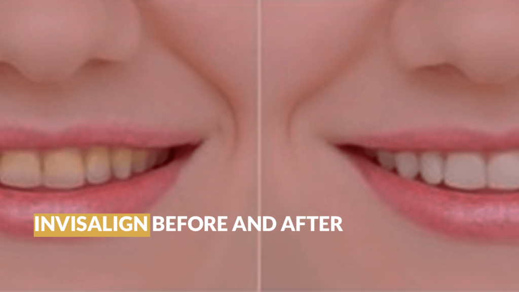 INVISALIGN BEFORE AND AFTER - Sherman Oaks Smile Studio
