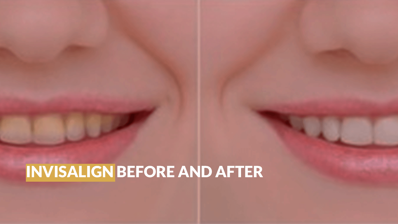 Invisalign before and after