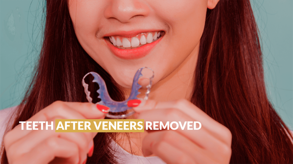 Teeth After Veneers Removed - Sherman Oaks Smile Studio