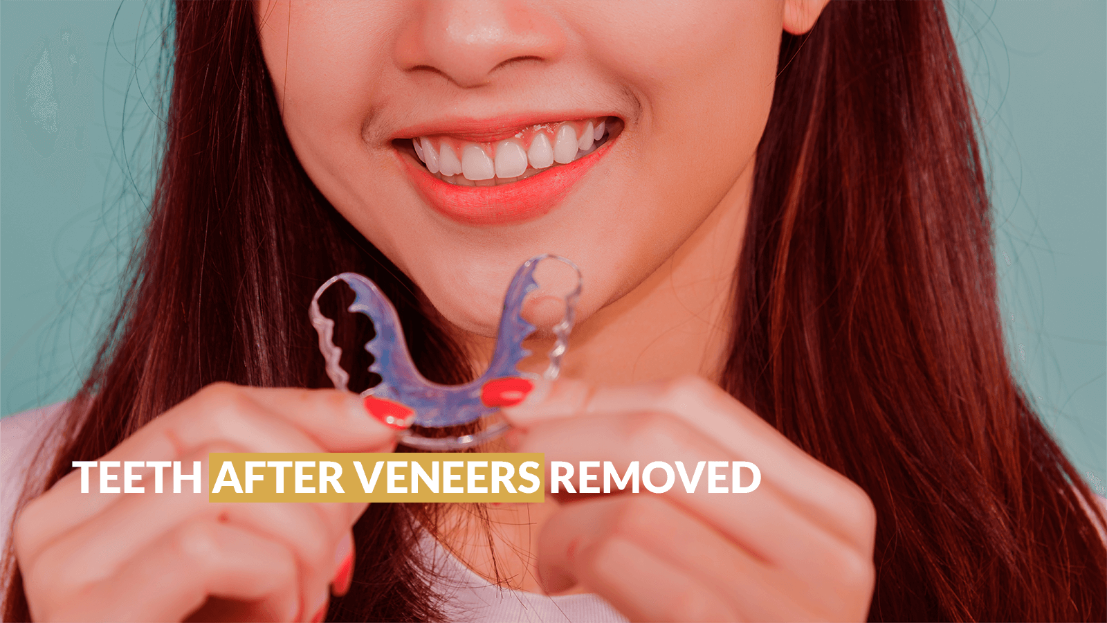 Teeth After Veneers Removed