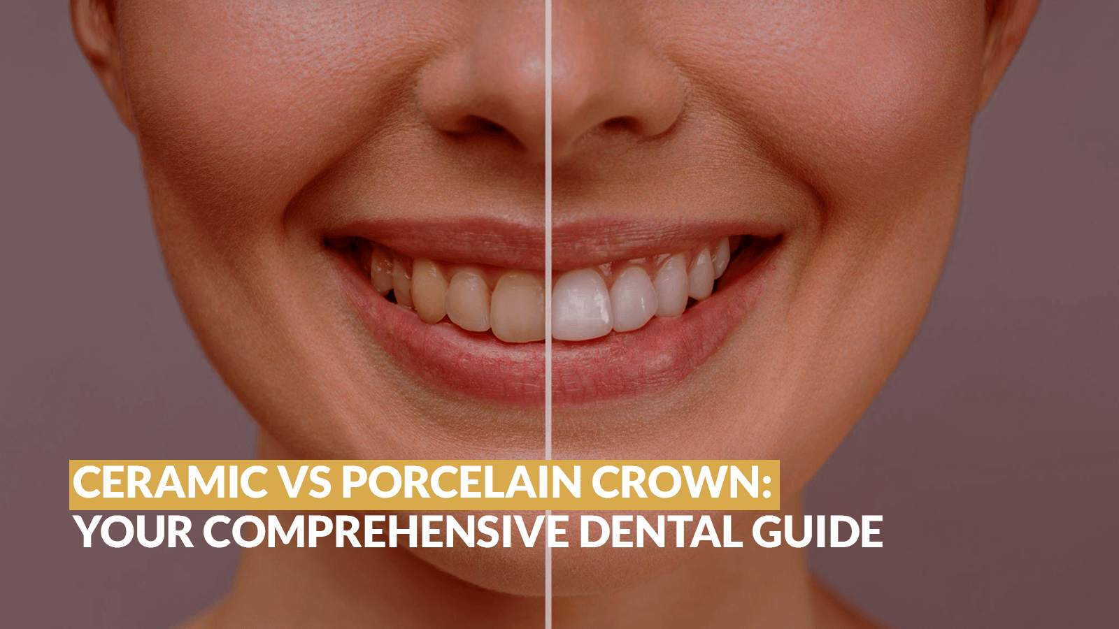 Ceramic vs Porcelain Crown: Comprehensive Dental Guide