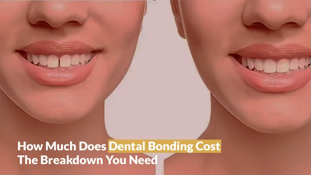 How Much Does Dental Bonding Cost? - Sherman Oaks Smile Studio