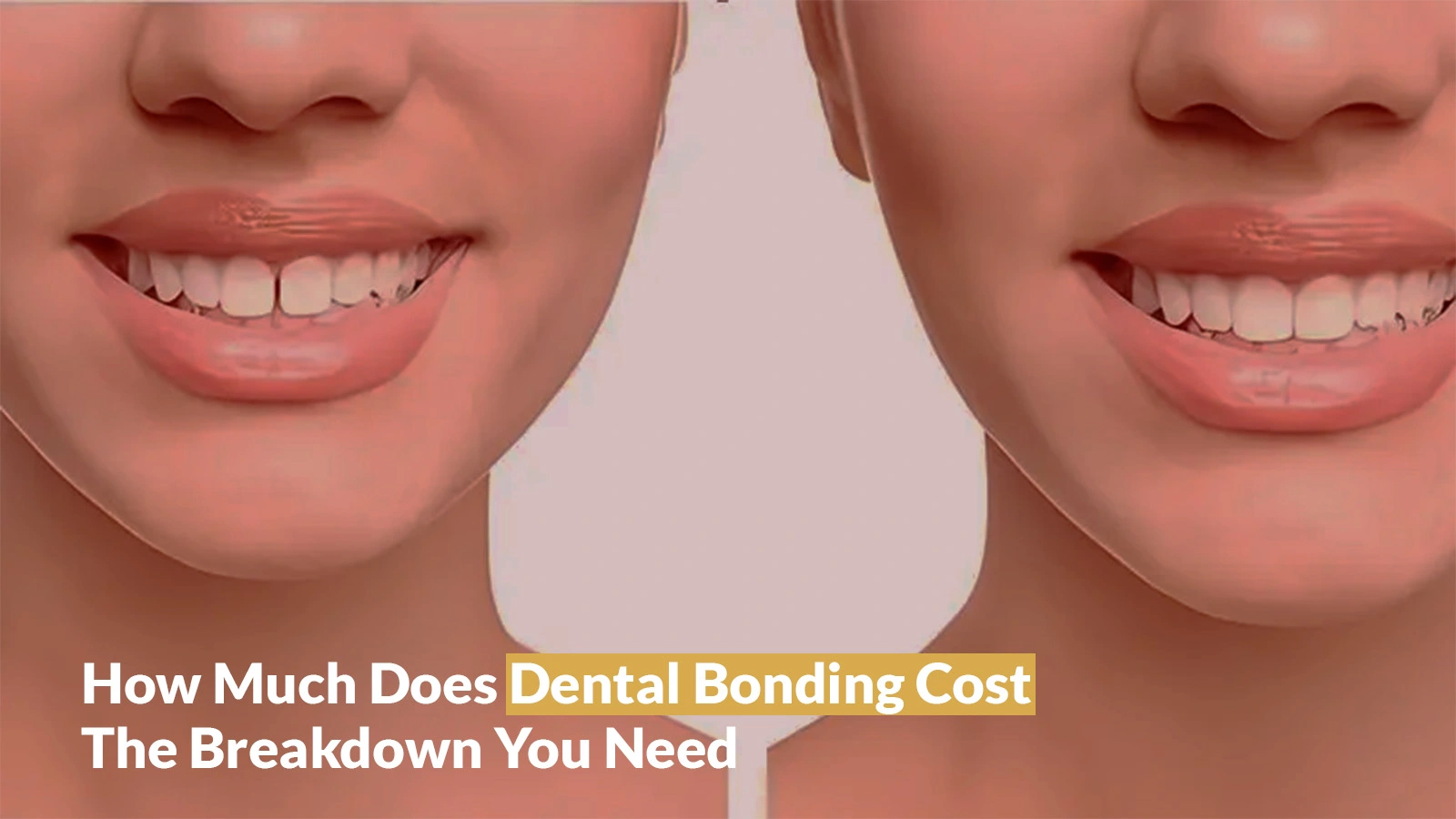 How Much Does Dental Bonding Cost: The Breakdown You Need
