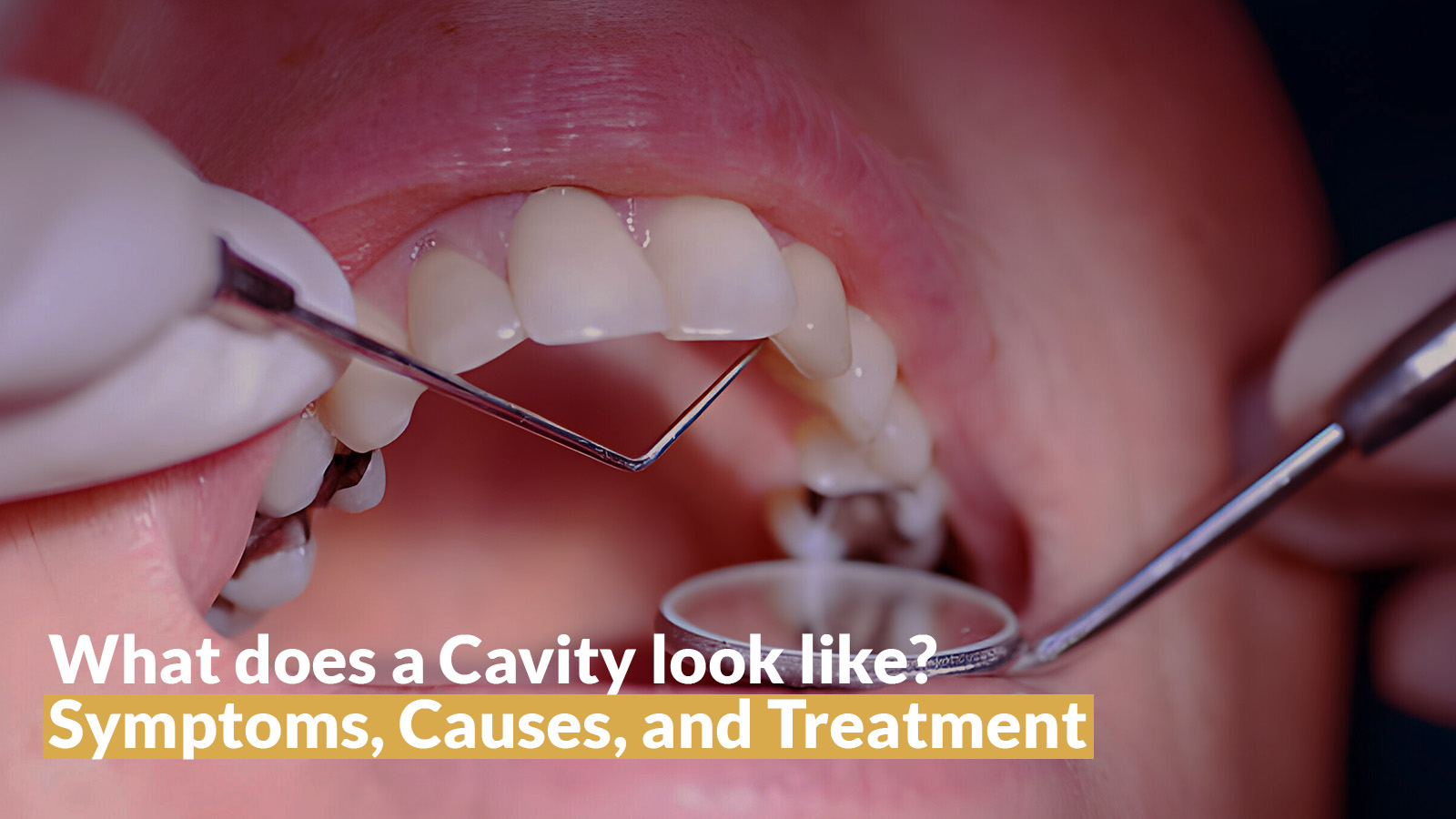 What does a Cavity look like? Symptoms, Causes, and Treatment.