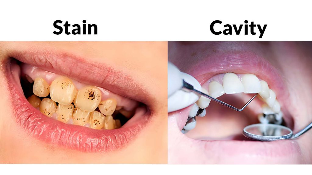 WHAT DOES A CAVITY LOOK LIKE? Stain vs Cavity - Sherman Oaks Smile Studio