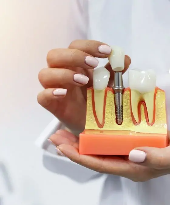 Dental Implants Sherman Oaks - Teeth Implants - Sherman Oaks Smile Studio