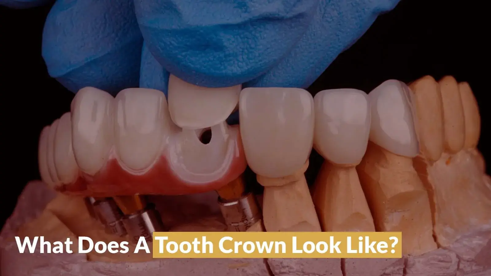 dental crown procedure being done
