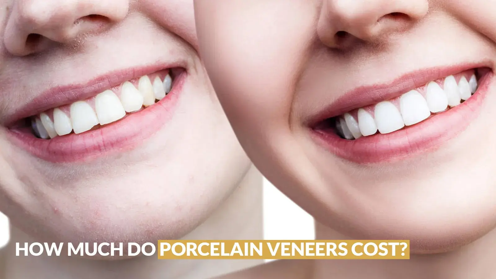 How much do porcelain veneers cost? - Sherman Oaks Smile Studio