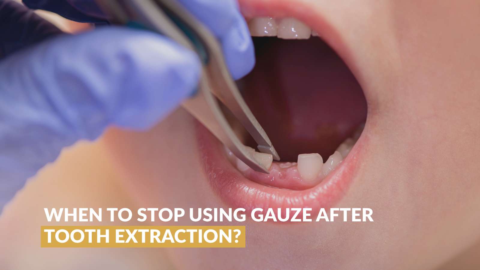 When to Stop Using Gauze After Tooth Extraction?