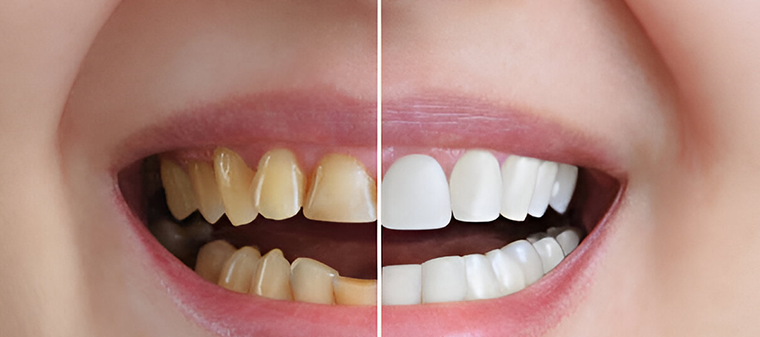 Before And After Image Of Cosmetic Dentist Sherman Oaks - Sherman Oaks Smile Studio