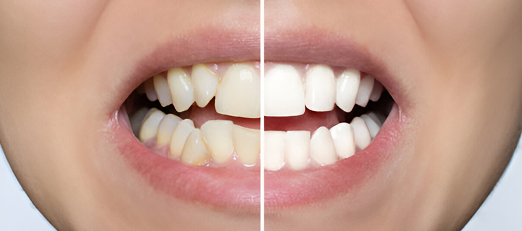 Before and after photos of a smile makeover - Cosmetic Dentist Sherman Oaks - Sherman Oaks Smile Studio