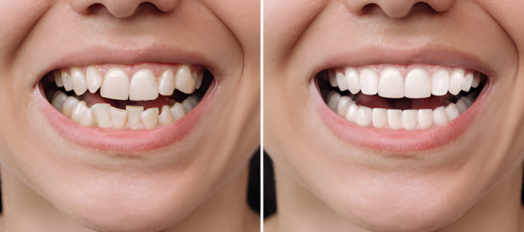 before and after cosmetic dentist sherman oaks - Sherman Oaks Smile Studio