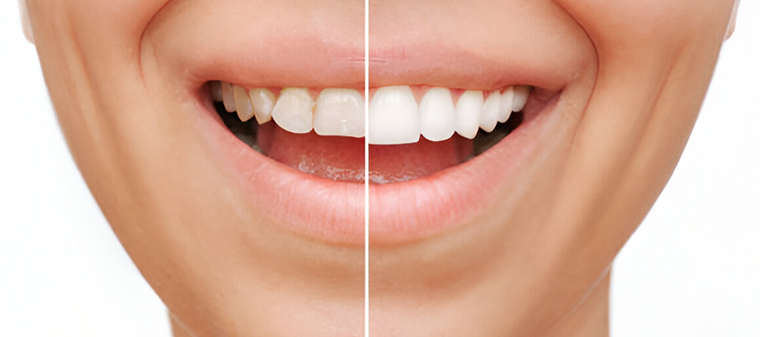 Cosmetic Dentist Sherman Oaks: Before and after of a smile makeover -Sherman Oaks Smile Studio