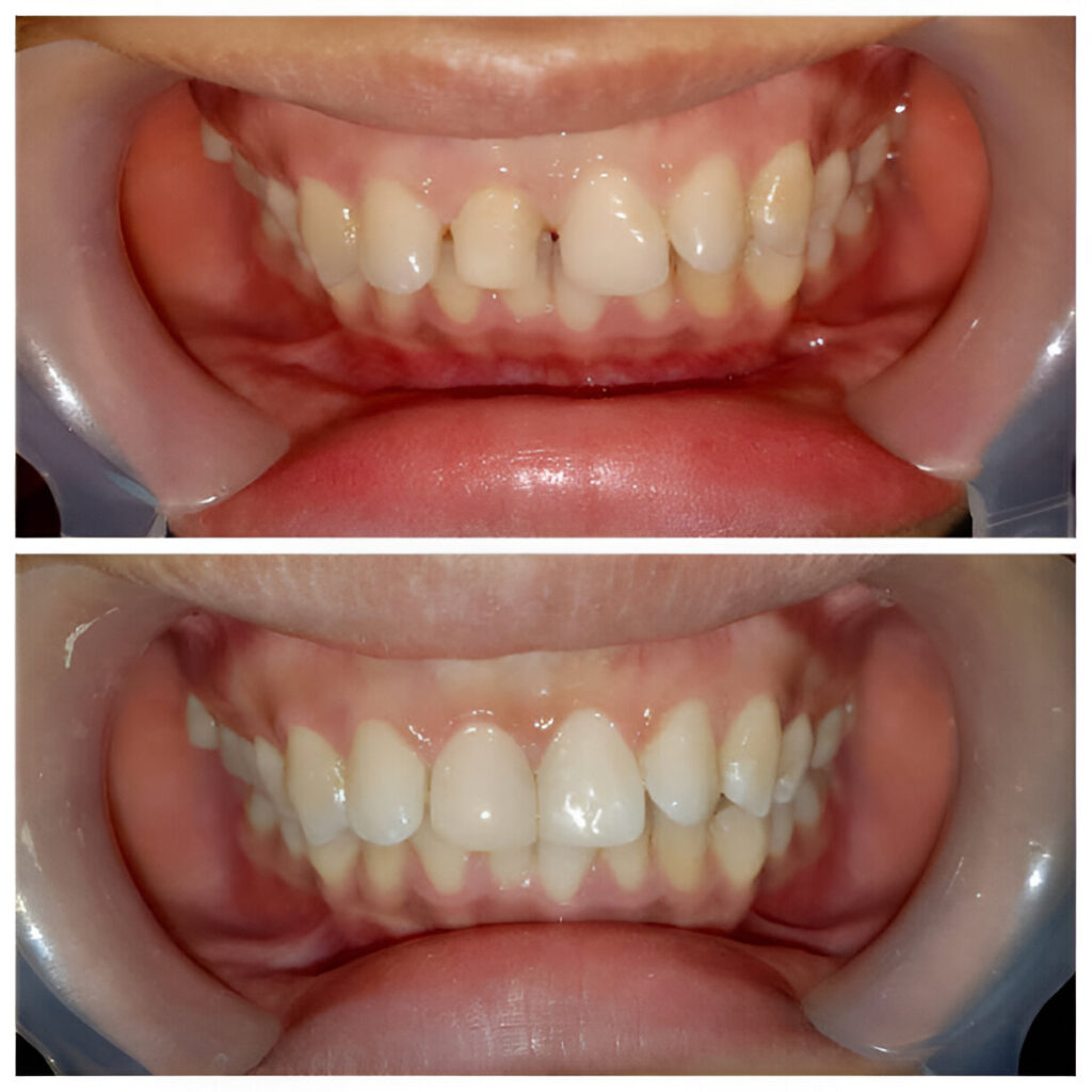 Cosmetic Dentist Sherman Oaks - Before and after photos - Sherman Oaks Smile Studio