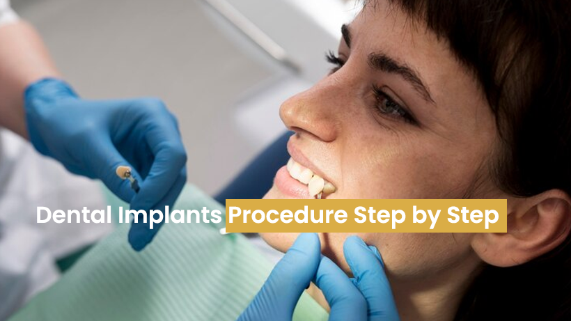 Dental Implants Procedure Step by Step